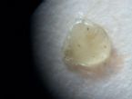 0052 Scalp scraping
