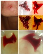 Large critters, ~2cm facial Extractions, thick walls