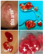 Chronic sores, extracted by esthetician