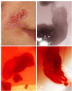 Skin extraction- face parasite, scar