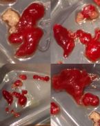 Facial Extractions, expelled from chronic sores