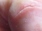 parasite entry wound right pinky finger ... (Click to enlarge)