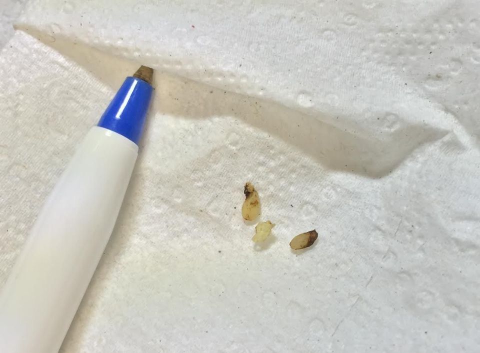 pin worms in poop pin worms in poop