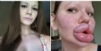 Lips Before and After Unbelievable ... (Click to enlarge)