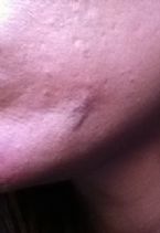cyst/scar