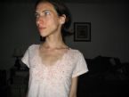 anorexia photo 004