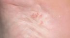 //www.curezone.org/upload/_A_Forums/Ask_CureZone/tn-blisters.jpg