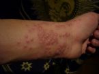 wrist rash ... (Click to enlarge)