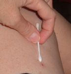 hole in leg caused by strongyloides larvae erupting from skin ... (Click to enlarge)
