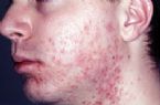 Folliculitis MRSA 004 ... (Click to enlarge)