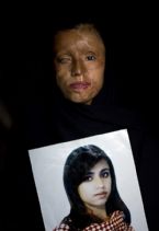 Burned by Islam husband ... (Click to enlarge)
