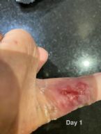 day 1 on Fenbendazole cancer protocol ... (Click to enlarge)