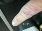 day 21 on Fenbendazole cancer protocol ... (Click to enlarge)