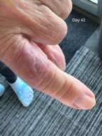 day 42 on cancer protocol picture2 ... (Click to enlarge)