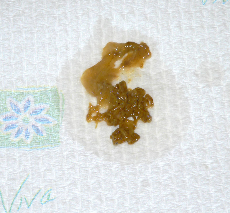 //www.curezone.org/upload/_C_Forums/Candida/candida02.jpg