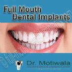 full mouth dental implants