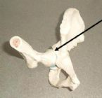 Hip Joint Subluxation