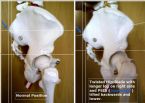 sacrum subluxation graphi