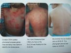 Eczema cured with elimination diet