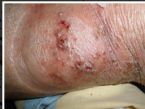 Eczema_behind.knee
