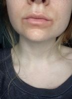 Mouth rash