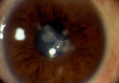 Streptoccocus pneumoniae keratitis Streptoccocus pneumoniae keratitis