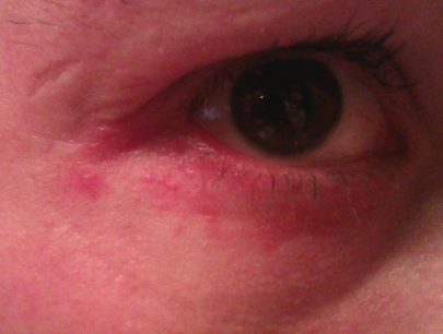 eye disease of some sort eye disease of some sort