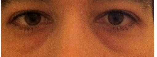 eye bags2 eye bags2