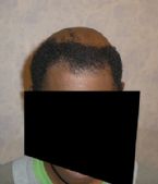 face scalp