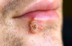 herpes simplex ... (Click to enlarge)