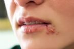 herpes simplex ... (Click to enlarge)