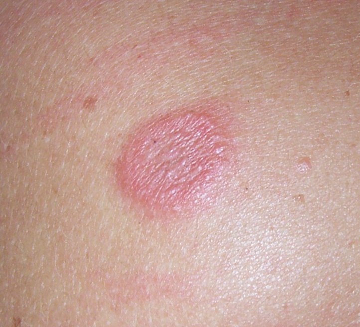 Spider Bite Reaction Rash