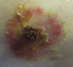 Big picture of the wart 20120301 ... (Click to enlarge)