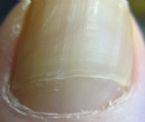 big toe nail