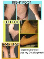 Stucco Keratosis Collage