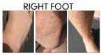 Stucco Keratosis 3-views ... (Click to enlarge)