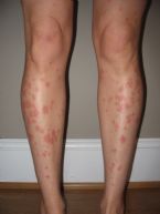 2008 Mar30 skinMerinaEczema 002 ... (Click to enlarge)