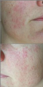 Mirena Induced Rash ... (Click to enlarge)