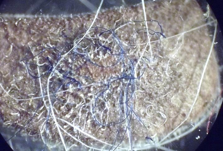 //www.curezone.org/upload/_M_Forums/Morgellons/0772.jpg