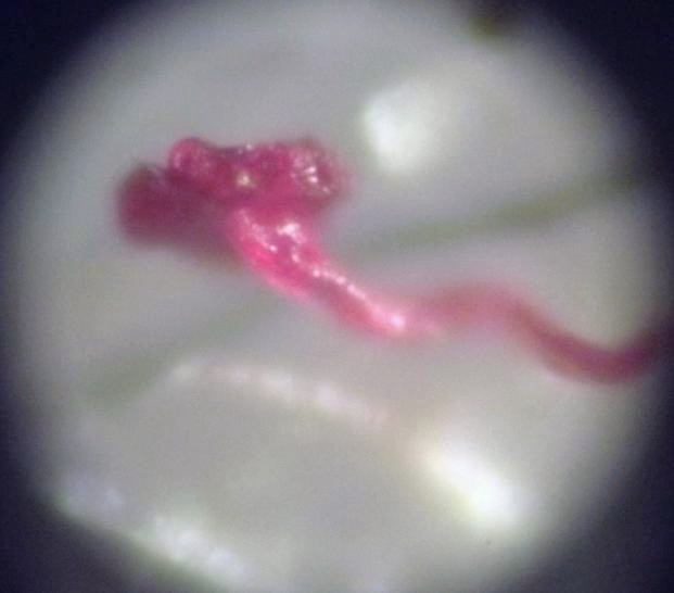 //www.curezone.org/upload/_M_Forums/Morgellons/219.jpg