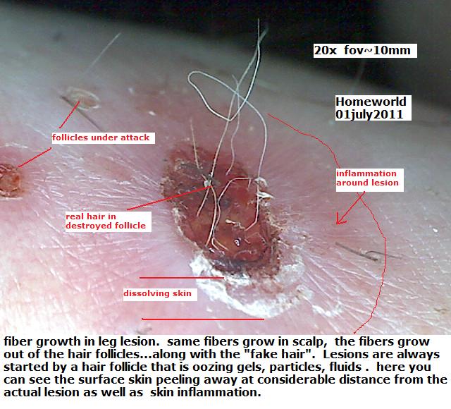 //www.curezone.org/upload/_M_Forums/Morgellons/FHW/lesions/leglesion1jul11.jpg