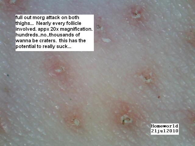 //www.curezone.org/upload/_M_Forums/Morgellons/FHW/morgattaack21jul10.jpg