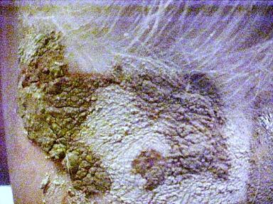 //www.curezone.org/upload/_M_Forums/Morgellons/MVC_014F.jpg