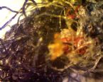 Morgellons-Blackhead Closeup
