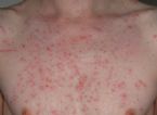 Urticaria ... (Click to enlarge)