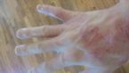 20160512 eczema rash after borax and peroxide and dish soap ... (Click to enlarge)