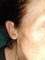 After skin tag removed with scraping of.toothpick...wormsss
