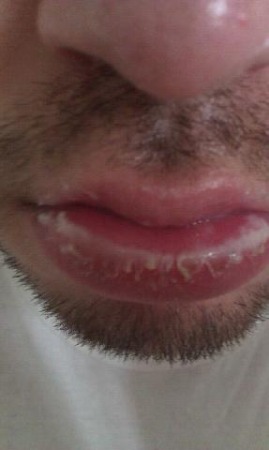 //www.curezone.org/upload/_O_P_Forums/Peeling_Lips/11e56aacc5ab_1580e4cf_a21f_4138_b04a_702a4463b16f.jpeg