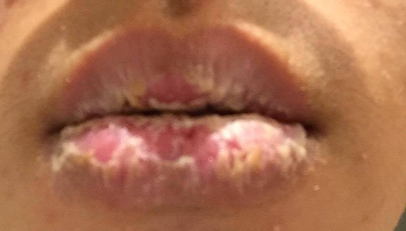 EC Healing Journey (I'm new here) at Peeling Lips Exfoliative Cheilitis