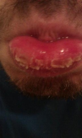 //www.curezone.org/upload/_O_P_Forums/Peeling_Lips/1b8cc6c8b910_324f5daf_f817_402b_9dc6_b2d7700a6fdc.jpeg